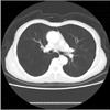 پاورپوینت بررسی و شناسایی بیماری ریه با طبقه بندی تصاویر اسکن ریه